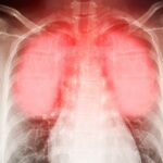 respiratory disease