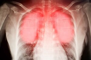 respiratory disease