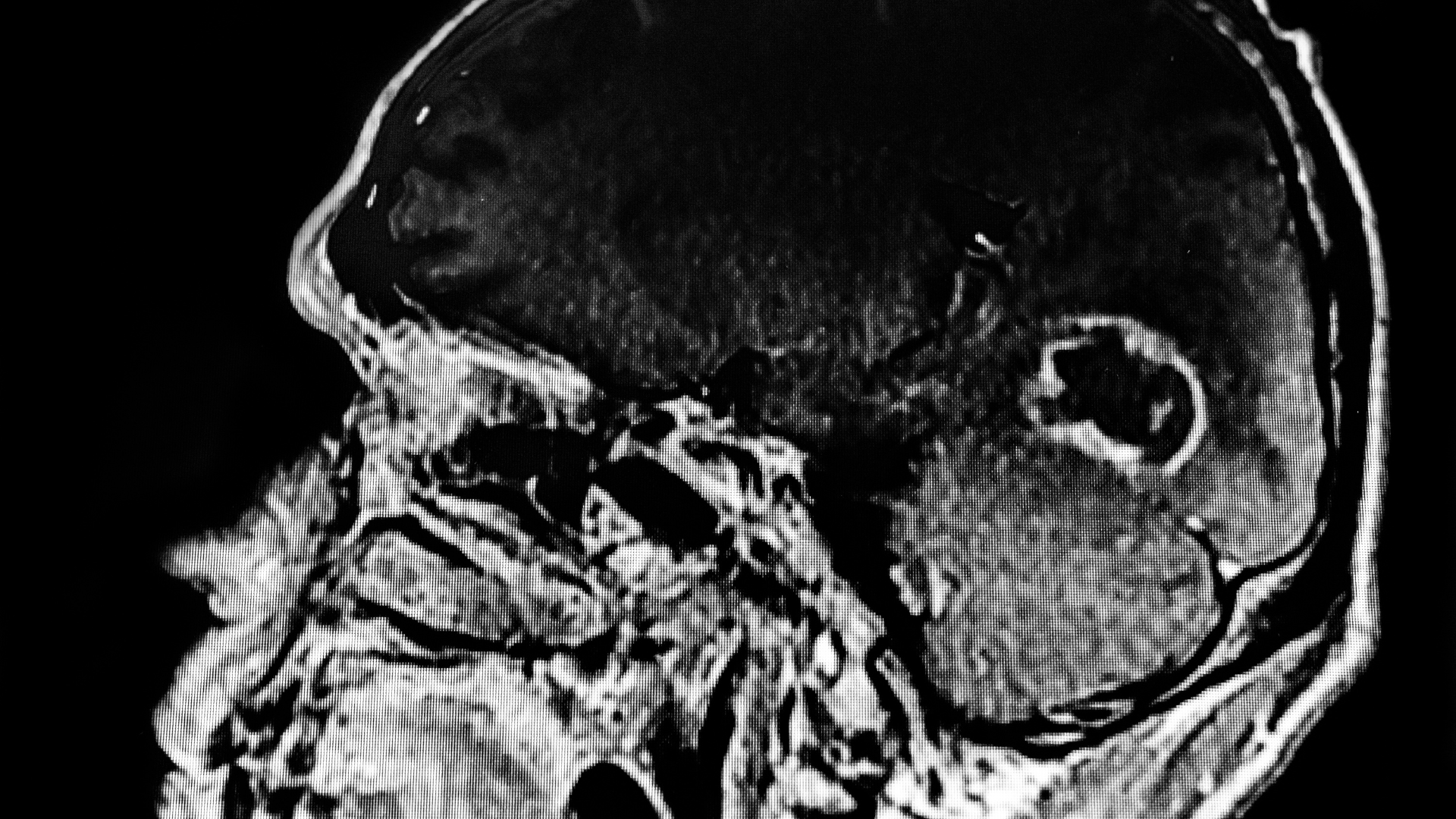 Toxoplasmosis Compensation Claim