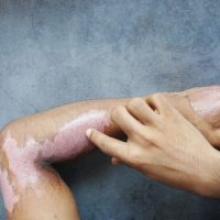 skin injuries